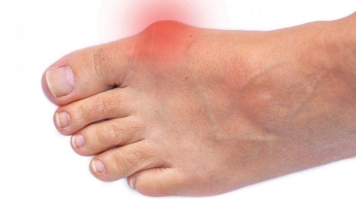 Redness and warmth in a gout-affected joint